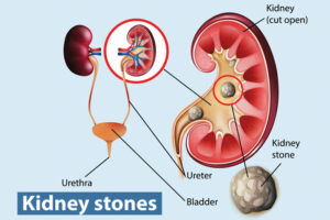 kidney-stones