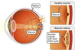 macular edema