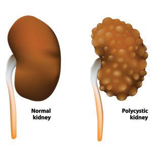 Polycystic kidney disease