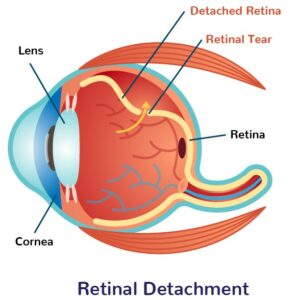 retinal detachment