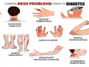 skin conditions in diabetes