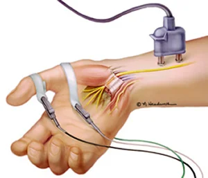 nerve conduction test