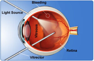 vitrectomy