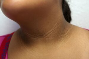 Acanthosis Nigricans 