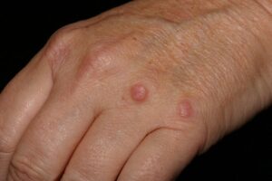 Disseminated Granuloma Annulare