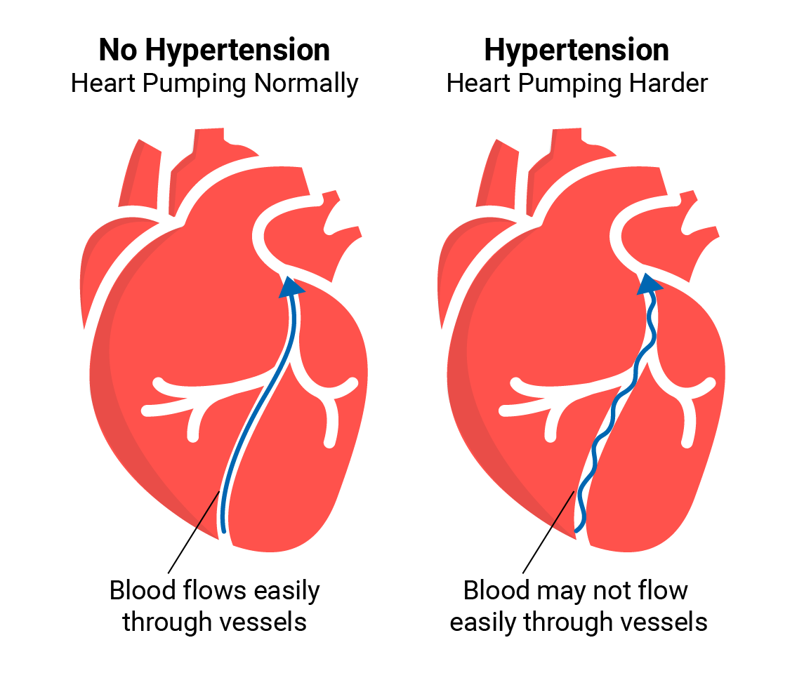 What is Hypertension And Normal Blood Pressure?