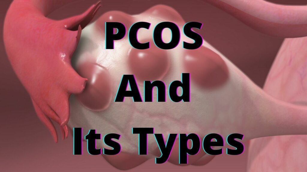 PCOS And Its Types