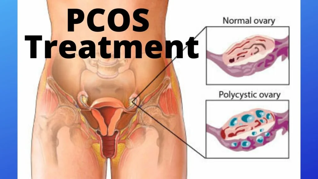 PCOS Treatment