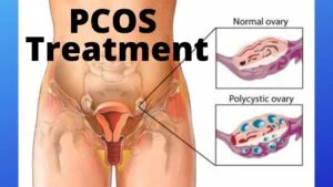 PCOS Treatment