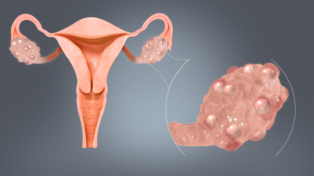 PCOS And Its Types: A Complete Comprehensive Guide