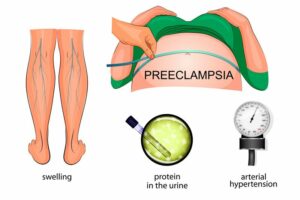 Preeclampsia hypertension in pregnancy