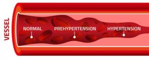 symptoms of hypertension