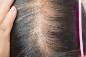 Thinning of hair on the scalp