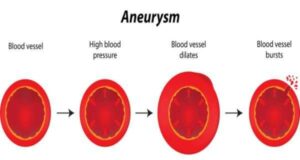 aneurysm complication of hypertension