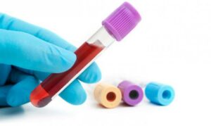 blood examination for pcos diagnosis