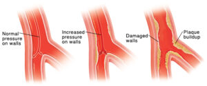 damaged artery