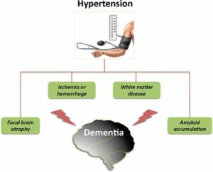 dementia hypertension complication