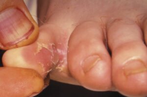 fungal skin infection and diabetes