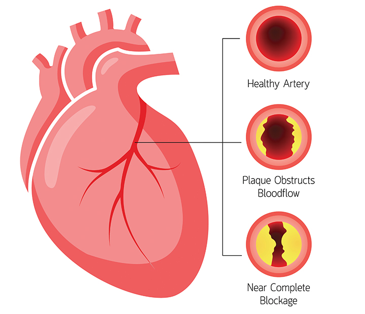 Complications of Hypertension or High Blood Pressure