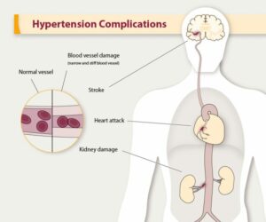 hypertension complications