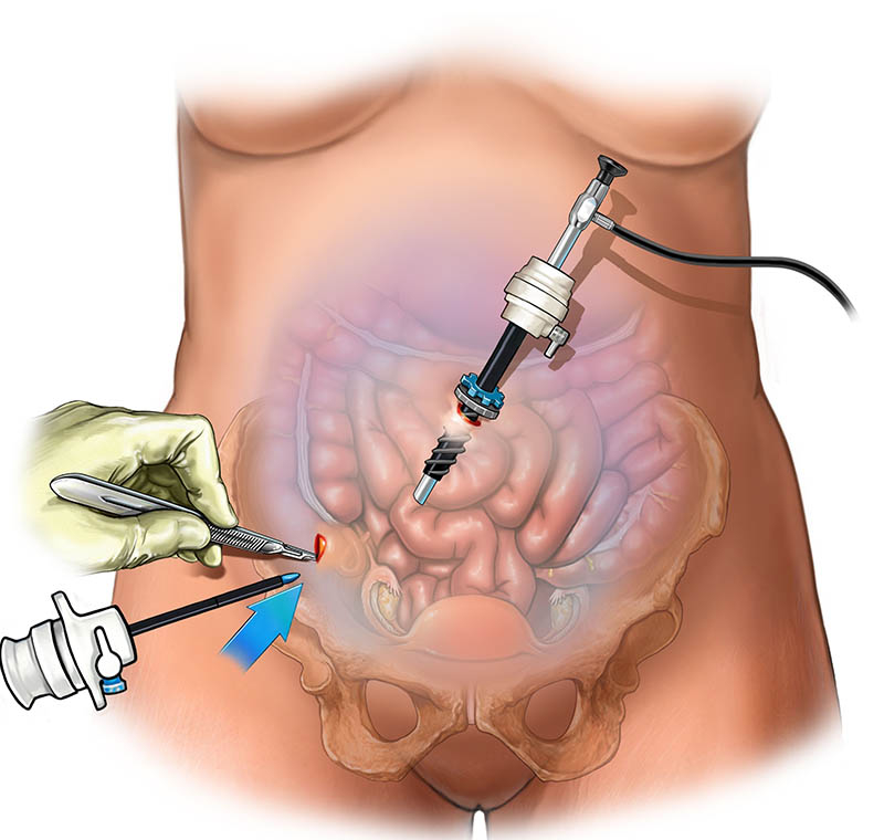 laparoscopy