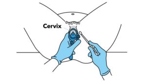 pelvic examination for pcos diagnosis