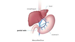 portal hypertension