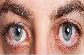 Graves' Ophthalmopathy