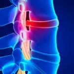 Herniated Disc
