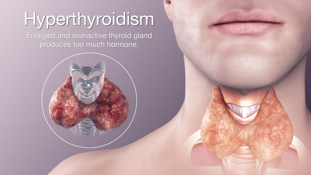 Hyperthyroidism Symptoms Diagnosis And Treatment 