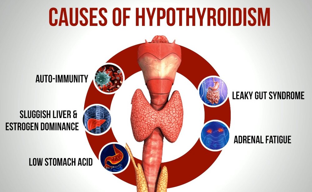 Causes Of Hypothyroidism