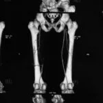 Lower-extremity Peripheral Arterial Disease