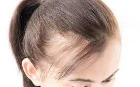Promotes Hair Growth and Prevents Baldness