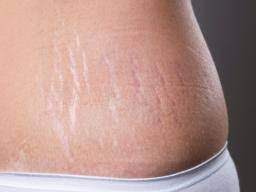 Reduces Appearance of Stretch Marks