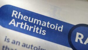 Rheumatoid Arthritis