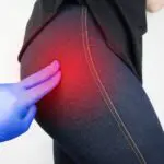 Sciatica