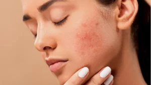 Treats Acne and Pimples