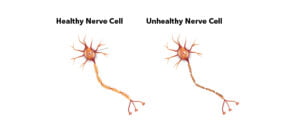 Neuropathy