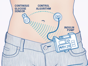 advantages of insulin pump