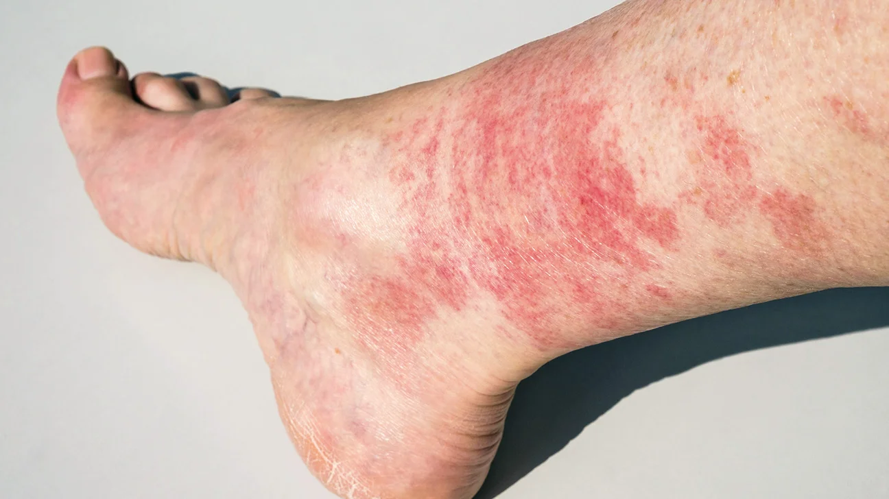 appearance on diabetic sores on legs