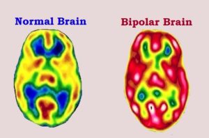 how bipolar disorder affects your life