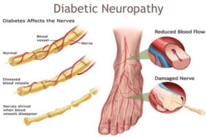 diabetic neuropathy