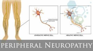 peripheral neuropathy