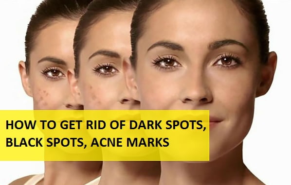 How to get rid of dark spots on black skin