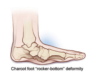 Charcot's foot