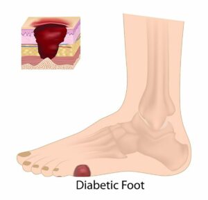 Diabetic Neuropathy Disease