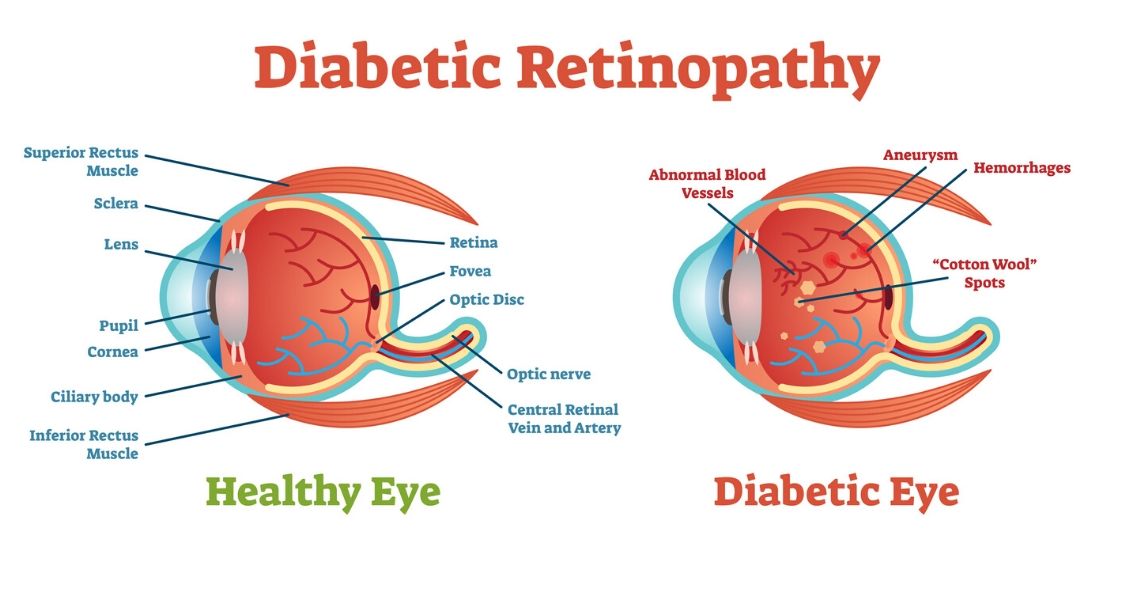 Diabetic Retinopathy