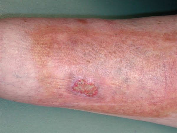 Diabetic Sores on Leg