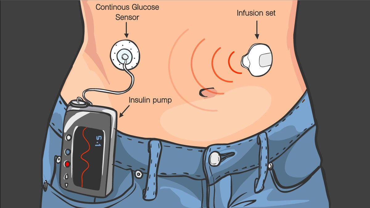 Insulin Pumps 