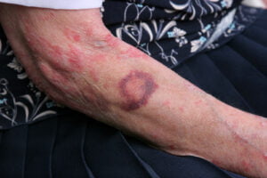 Physical Signs Of Elder Abuse